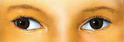 Divergent Squint