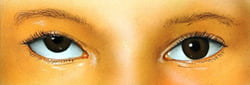 Vertical Squint