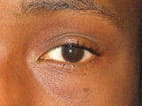 cataract-case1After