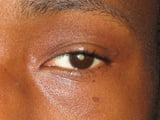 cataract-case1Before