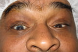 cataract-case2After