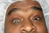 cataract-case2Before