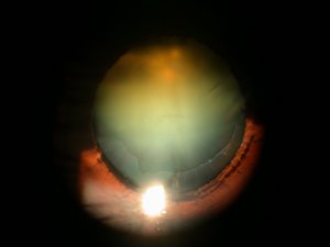 cataract-case3Before