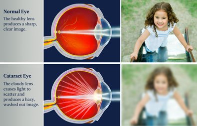 cataracts treatment cataracts treatment
